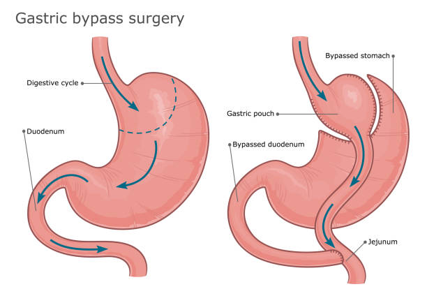 Guidelines for Seeking Qualified Care for Gastric sleeve & Bypass Surgery post thumbnail image